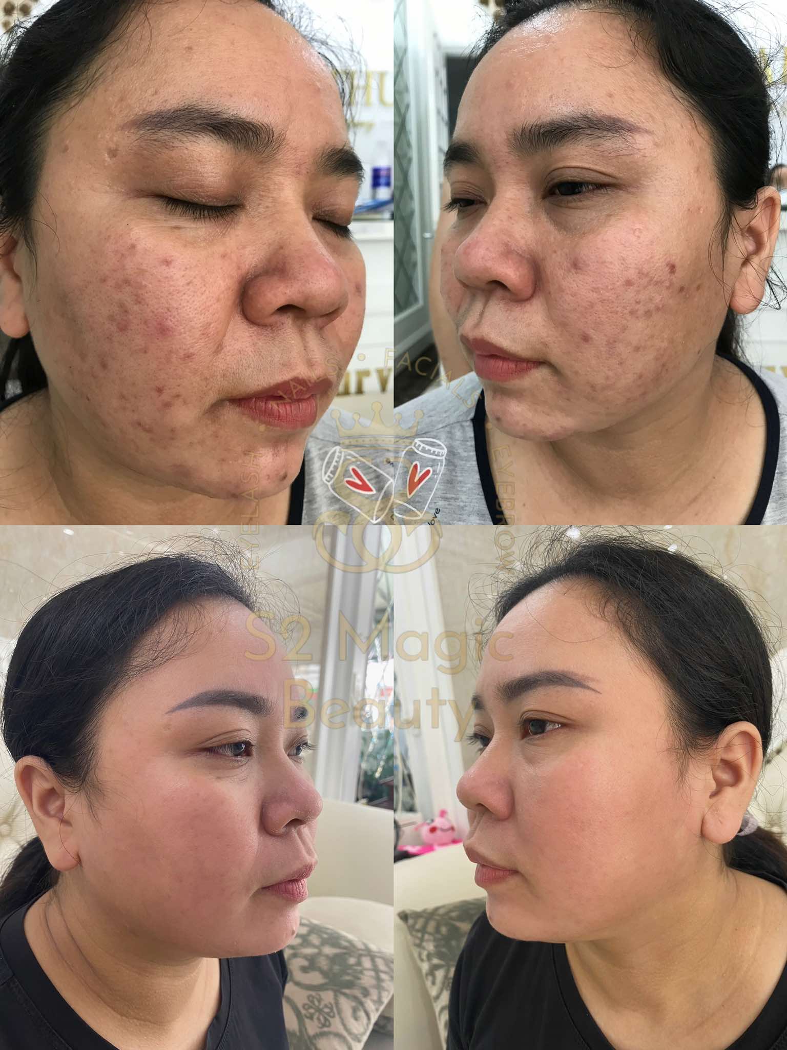 Image Phương Dung image beautiful image beautiful image beautiful image beautiful image beautiful - Acne Extraction Treatment – S2 Magic Beauty